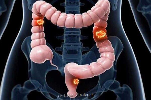 افزایش شدید موارد سرطان روده بزرگ در کودکان و نوجوانان